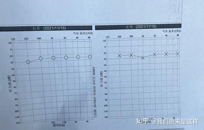 突发性耳聋的治疗过程