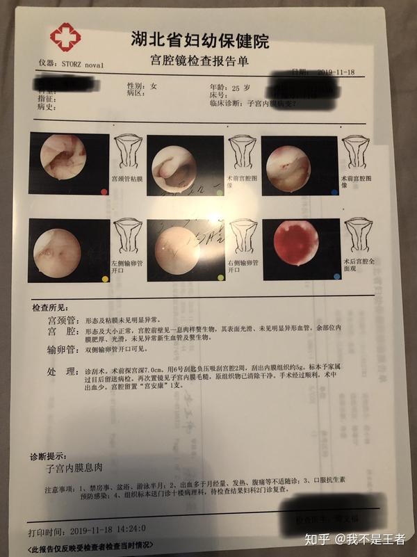 子宫内膜息肉宫腔镜手术过程二次复发及治疗