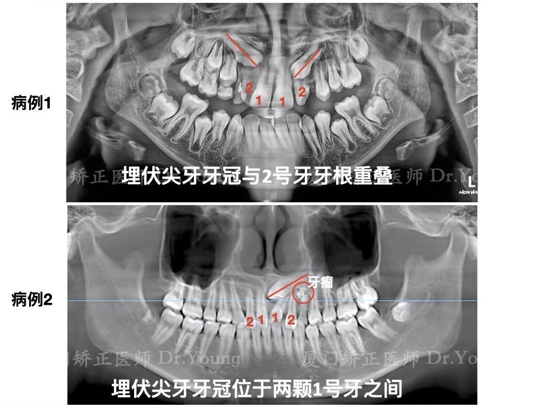 厦门牙齿矫正 | 定期拍片早期干预的重要性