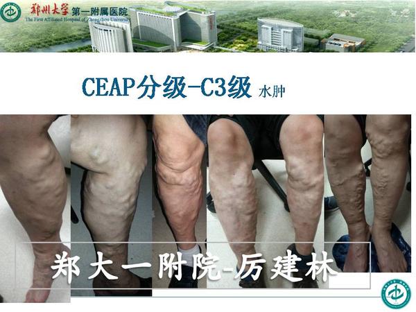 下肢静脉曲张ceap分级