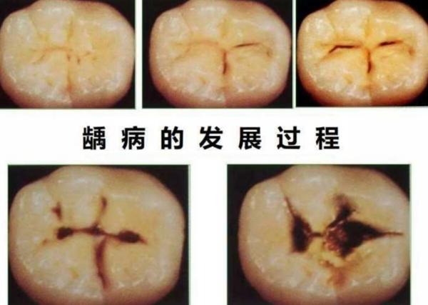 第一步:浅龋 治疗:定期观察或者补牙充填.