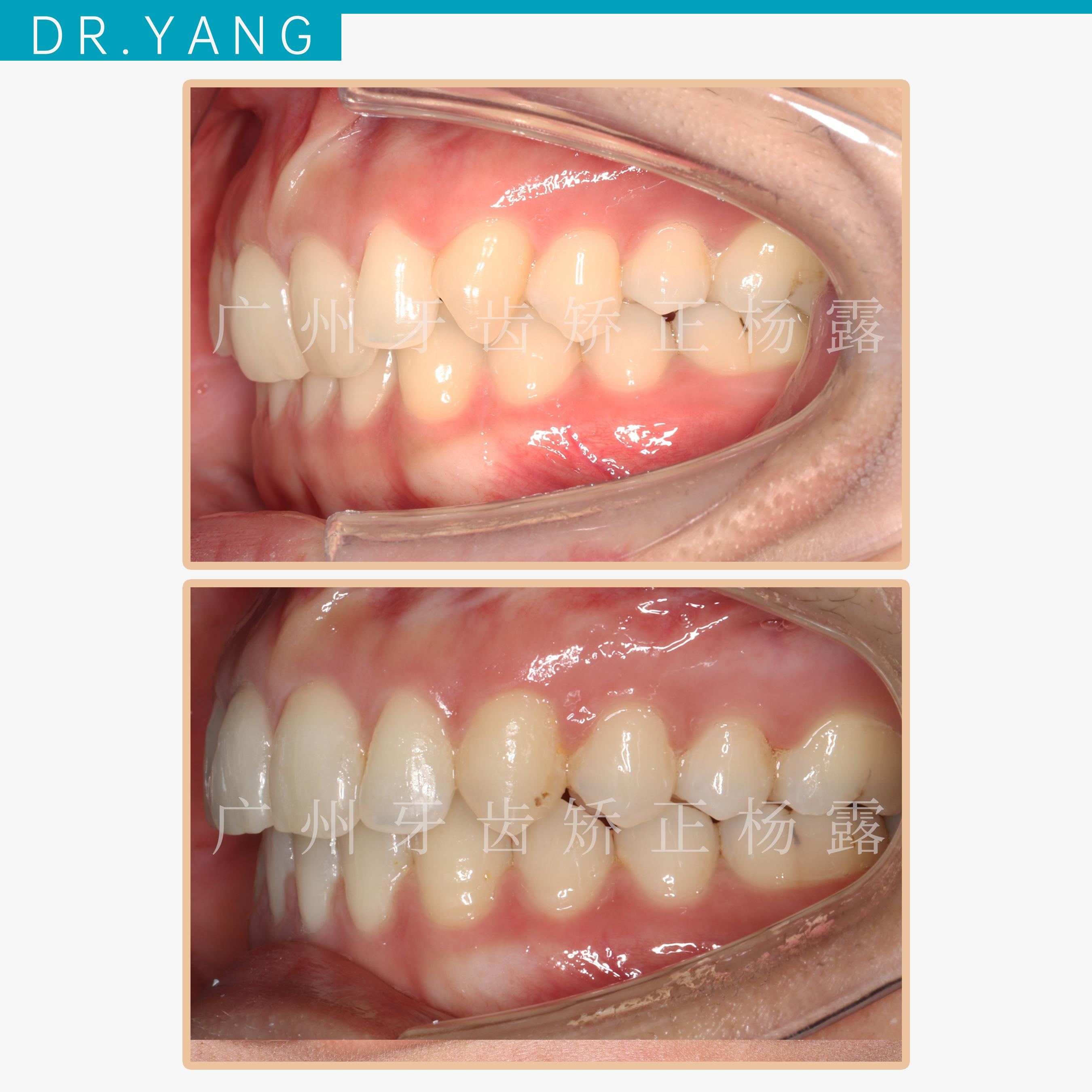 广州整牙缺失牙前牙内扣14个月时间实现笑容质变