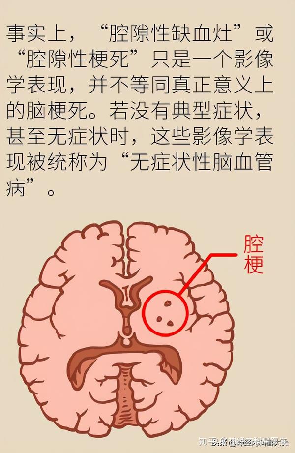 体检发现腔隙性脑梗死,需要吃阿司匹林和他汀吗?它的危害有多大