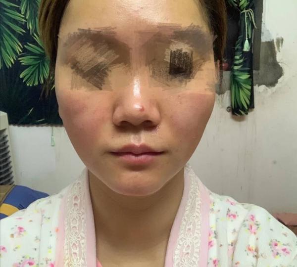 线雕的后遗症都有哪些?