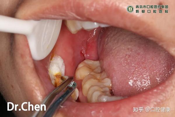 3,术后一周拆线,患者拔牙术后反应轻.