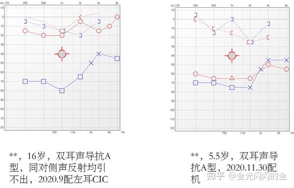 传导性听力损失的治疗