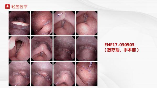 【轻盈医学】下咽后壁癌伴室性早搏,肺气肿的术式详解