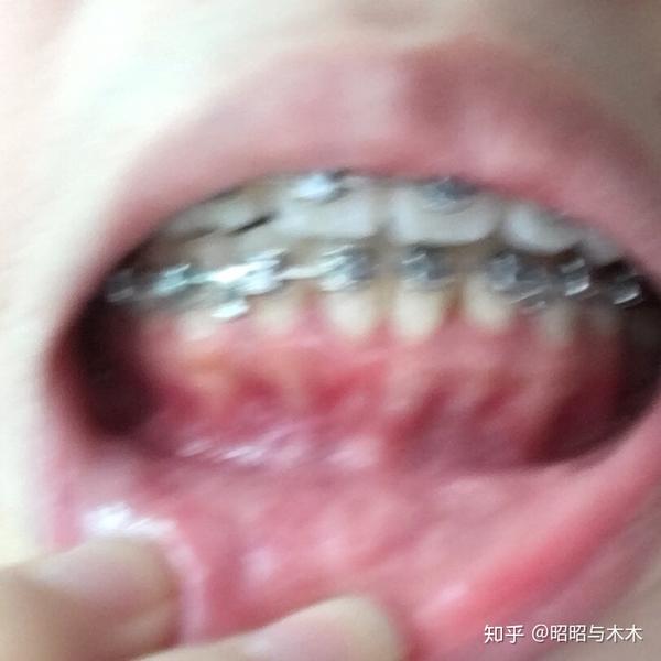 成人正畸后牙齿松动的真凶骨开窗