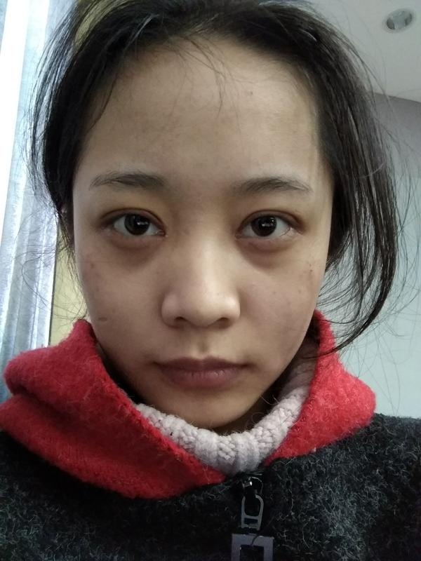 双眼皮全切6mm开眼角