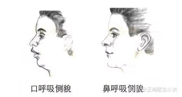 你知道口呼吸吗