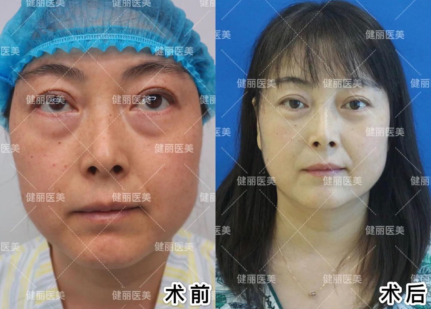 去眼袋后她的卧蚕竟然"长"出来了?