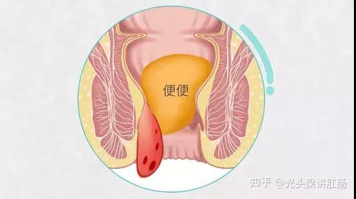 重庆肛肠医院:内痔"肉球"怎么收回去呢?