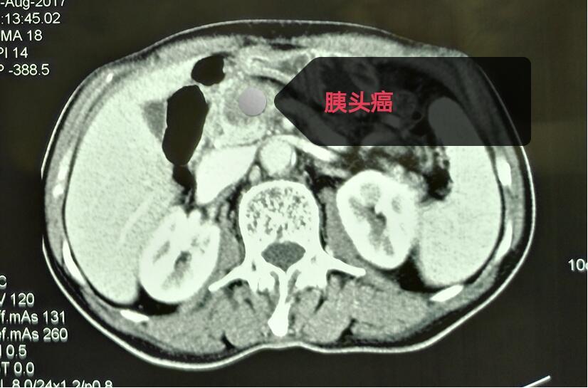 77岁胰腺癌该如何进行治疗