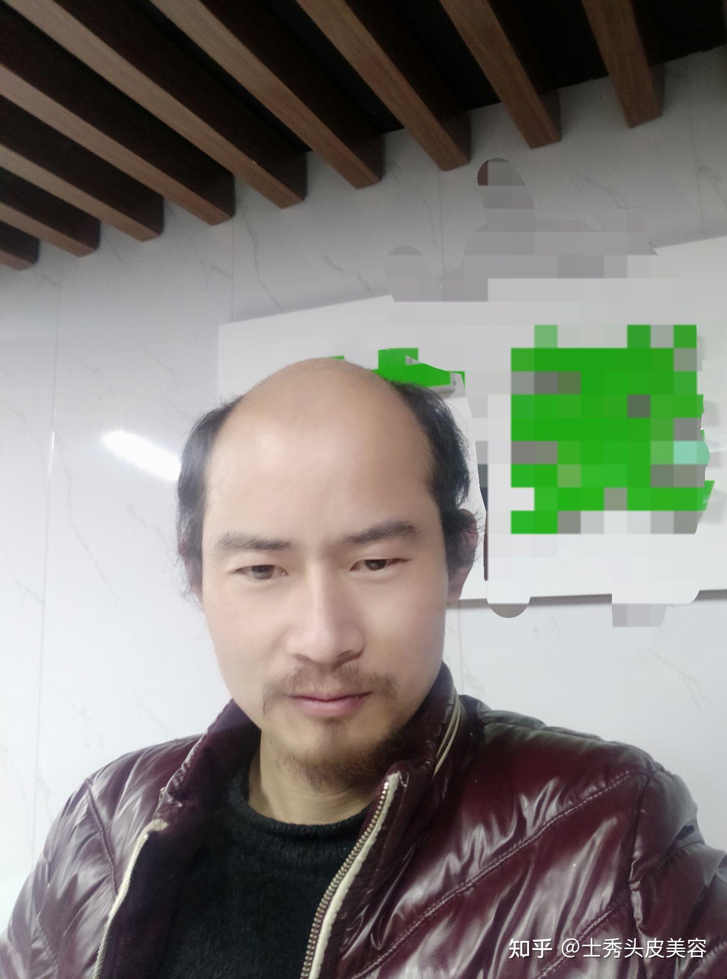 如何改变奔四秃顶大叔的形象?