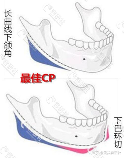 爱美容研社:下巴截骨和环切手术过程有什么区别?这里有你不知的秘密!