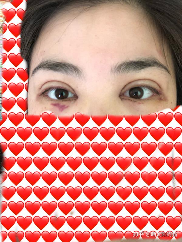 全切双眼皮历程