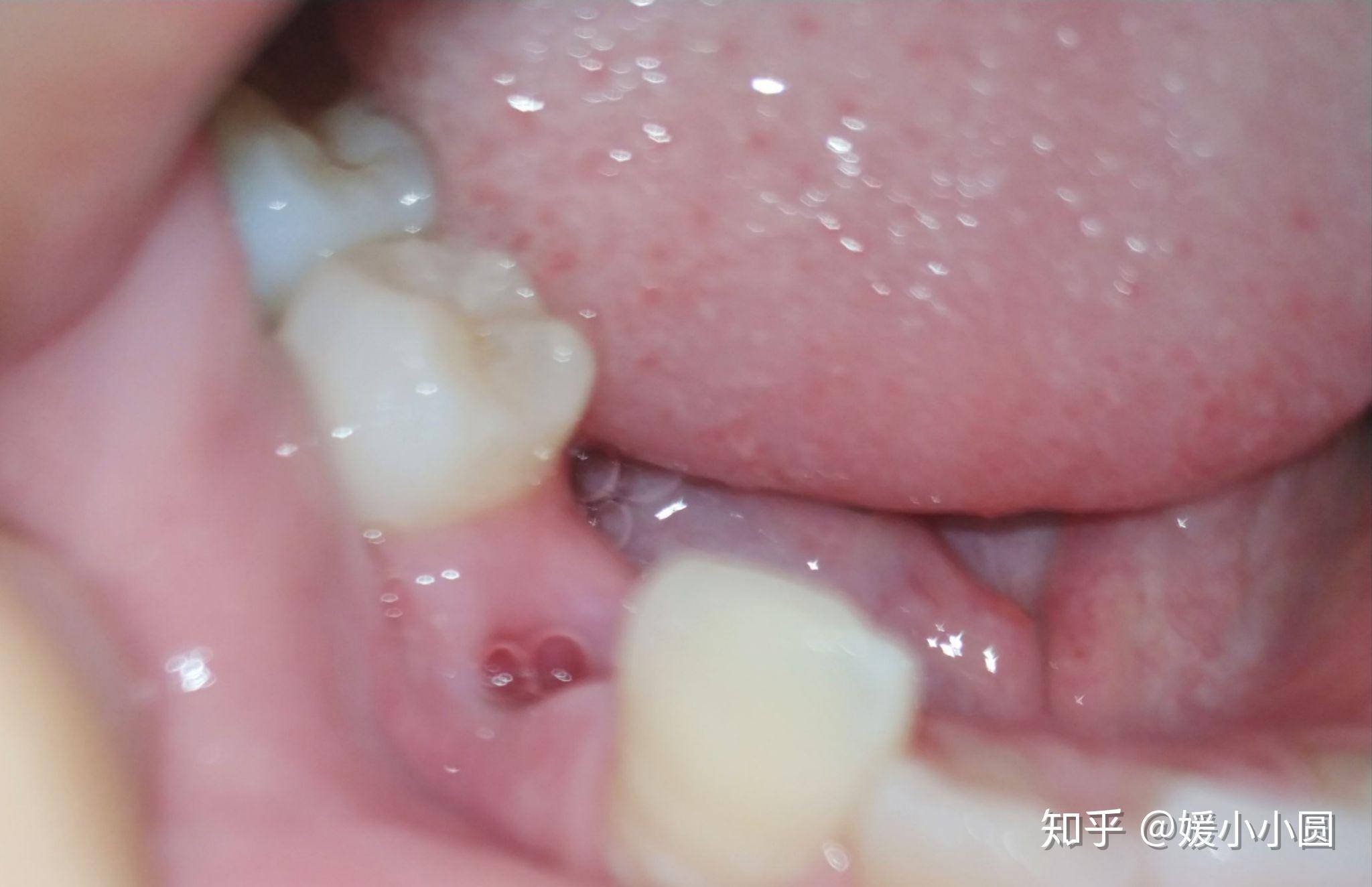 牙齿矫正拔牙恢复篇有图可能有点血腥