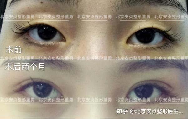 董勇案例全切双眼皮开内眼角术前术后两个月对比
