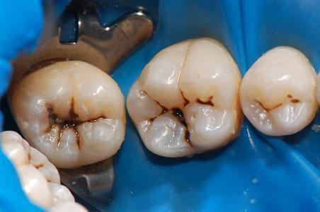 一般来说,拔牙的情况很少,除非做治疗已经没有太大意义,或者牙根也