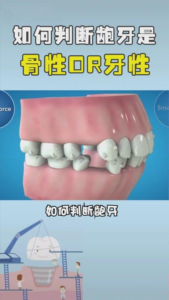 如何判断龅牙是牙性还是骨性?