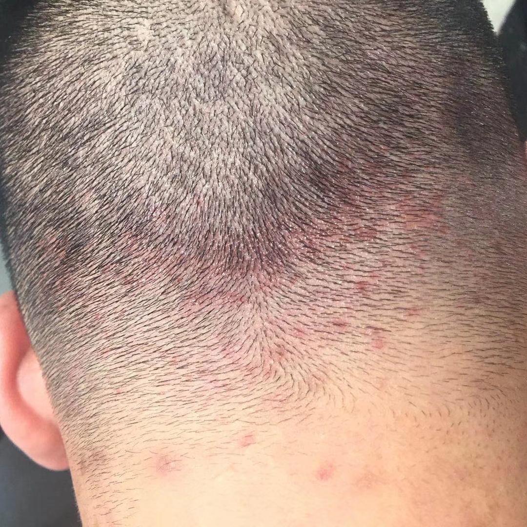 我是如何治愈头皮毛囊炎的