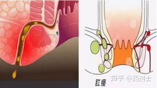 肛瘘是指肛门周围的肉芽肿性管道,也是一种皮肤软组织的炎症性疾病