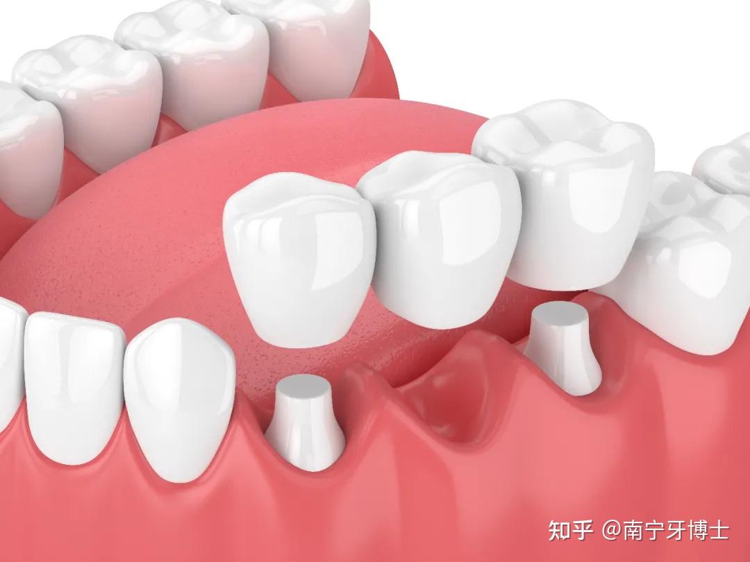 3种常见的缺牙修复方式详解看完摆脱选择困难