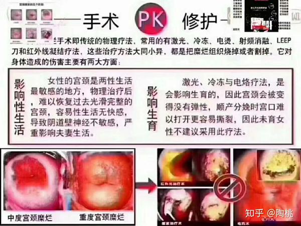 电波结痂手术女人一生顶多能做三次 做得越多,[惊恐]宫颈癌的几率越高