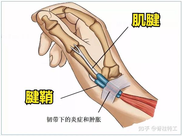 腱鞘炎3个阶段专业康复怎么做