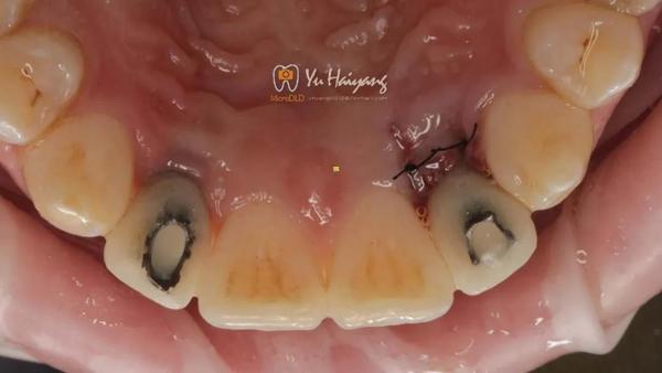 正畸牵引联合氧化锆基台修复双侧侧切牙缺失1例