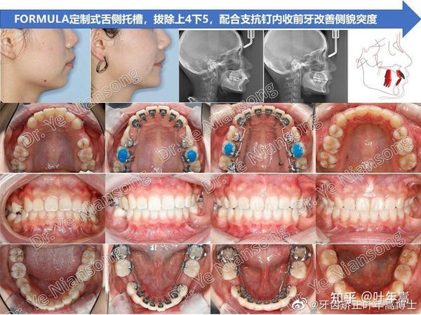 舌侧矫正拔牙内收改变侧貌一例