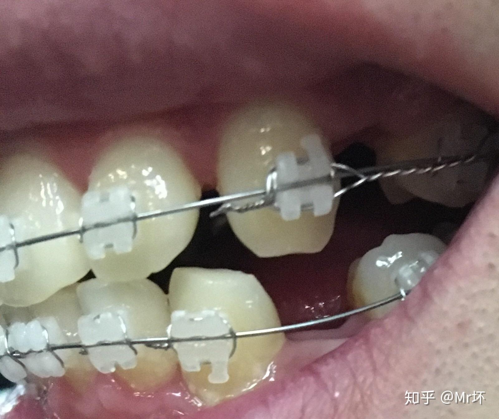 龅牙矫正过程记录已经下牙套咯