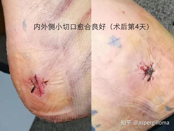 跟骨骨刺保守治疗无效后可以考虑微创手术治疗
