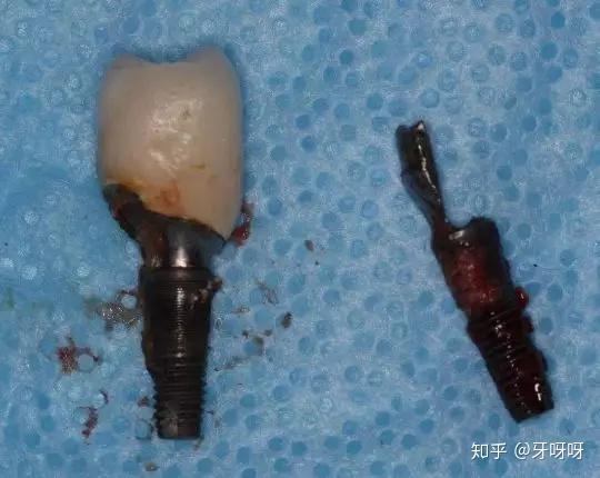 感染是种植牙失败的主要原因,若是骨量不够的患者,必须在植牙前填充
