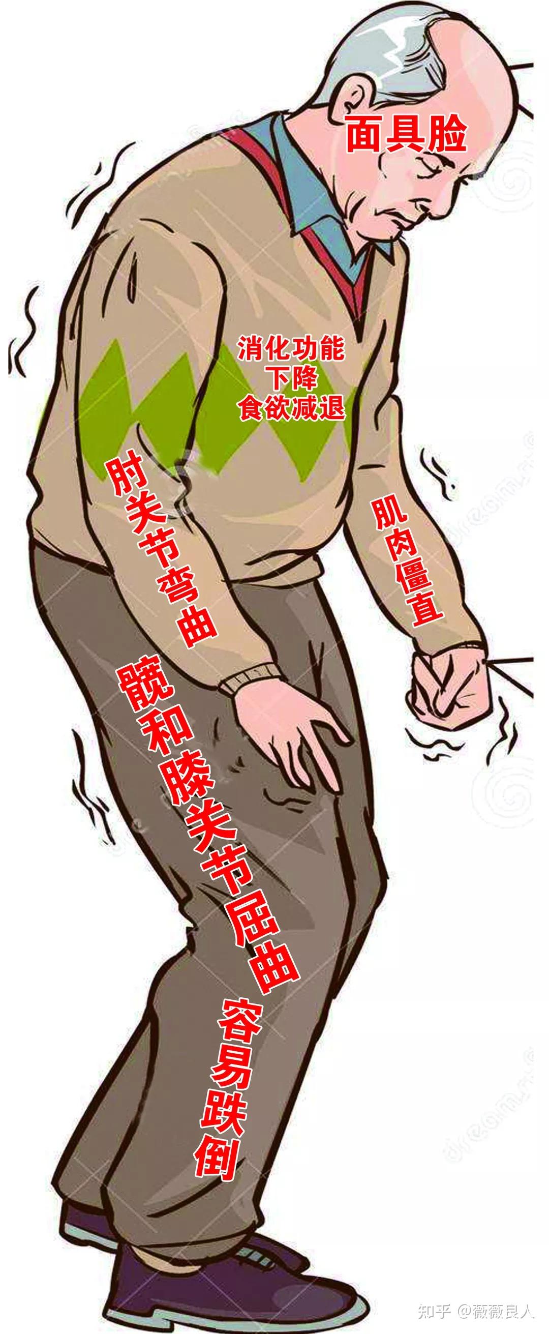 十个问题自测帕金森病风险