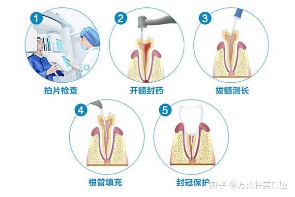 东莞牙齿根管治疗需要多少钱收费介绍