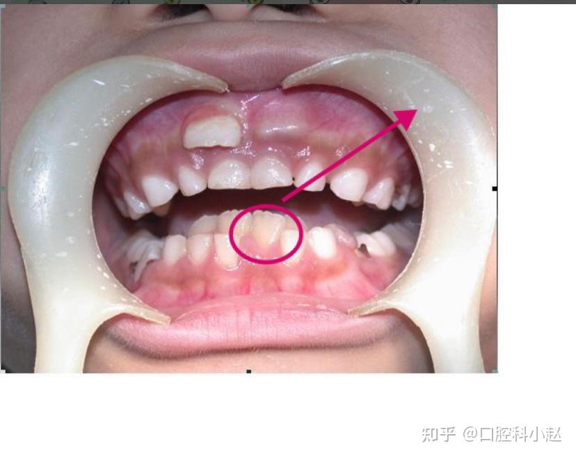 牙齿在生长过程的时候会有小裂纹吗