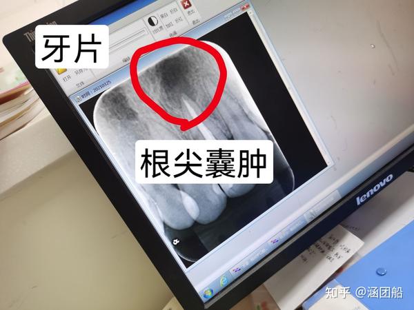 我的根尖囊肿切除术