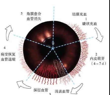 上皮(角膜第一层)损伤:角巩膜缘上皮细胞开始像病变部位移行,移行过程