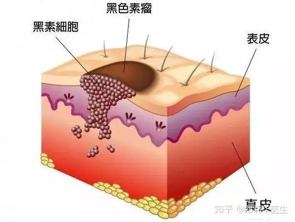 什么是黑色素痣