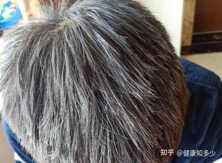 青少年长白头发是怎么回事