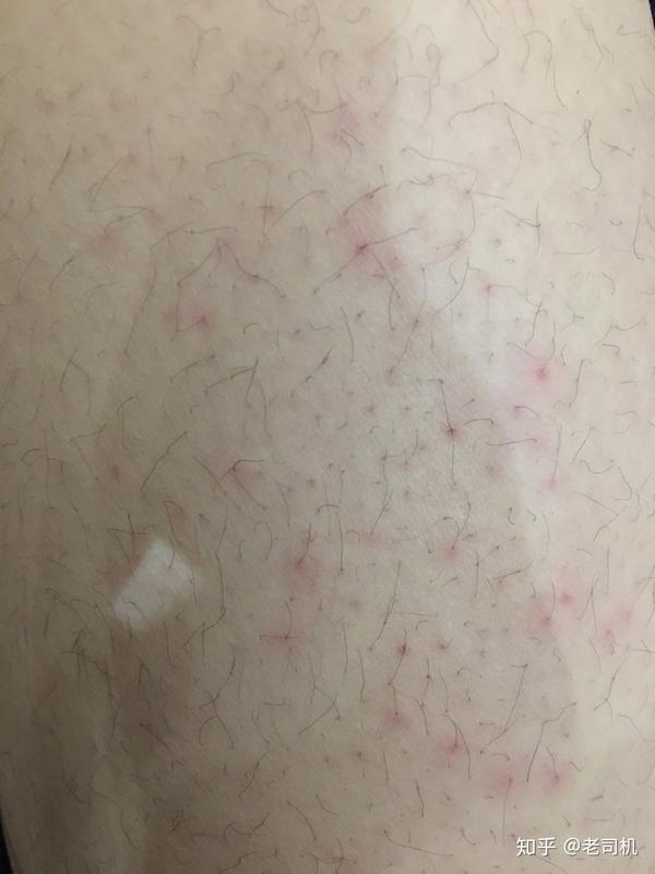 大腿起了一些红点,不疼不痒.