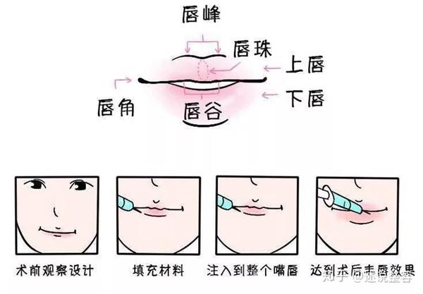 你的嘴唇是什么类型进来看看玻尿酸丰唇的注射方法及常见问题