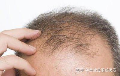 脱发是怎么回事 zhuanlan.zhihu.com