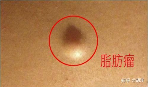 脂肪瘤这种恼人的小疙瘩,有时也会兴风作浪,这些部位长瘤需注意
