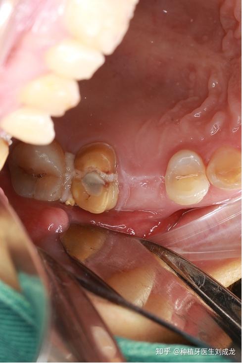郑州种植牙磨牙区多颗瑞士iti种植案例