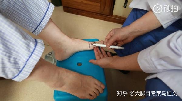 拇外翻的发生与多种因素有关,如穿窄小高跟鞋,扁平足, 跖骨过长,过短