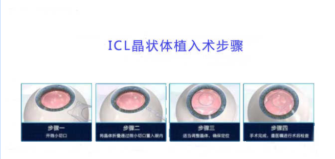 什么是icl晶体植入近视手术