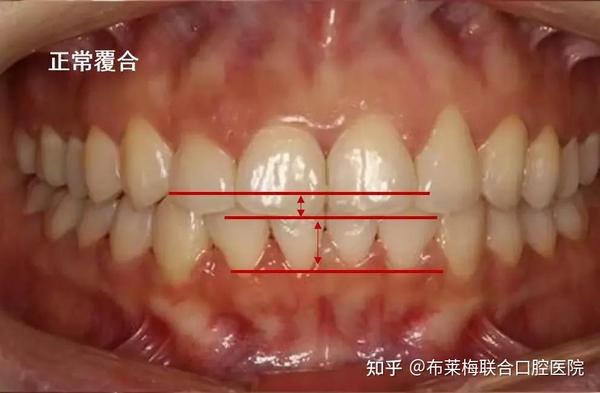 1/3以上或下前牙咬合于上前牙舌侧1/3以上,垂直距离过大,是上下关系