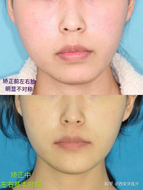大小脸能不能矫正?